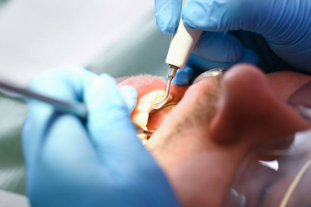 Best Emergency Tooth Extraction in Bryan, OH
