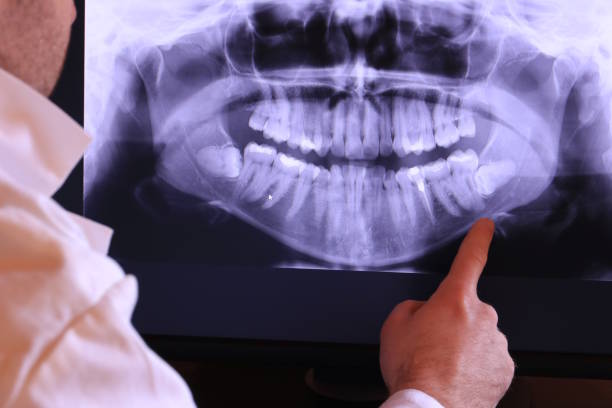 Best Emergency Wisdom Teeth Removal in Bryan, OH